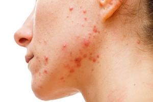 Spa trị mụn hiệu quả nhất Tiền Giang